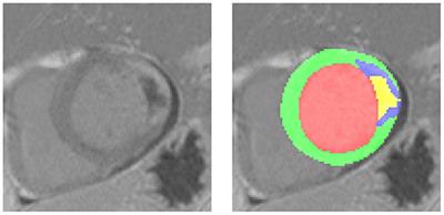 Prediction of Myocardial Infarction From Patient Features With Machine Learning